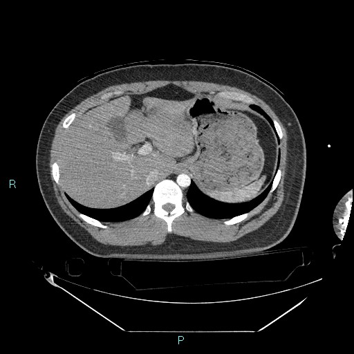 Bronchial carcinoid tumor (Radiopaedia 78272-90870 B 111).jpg