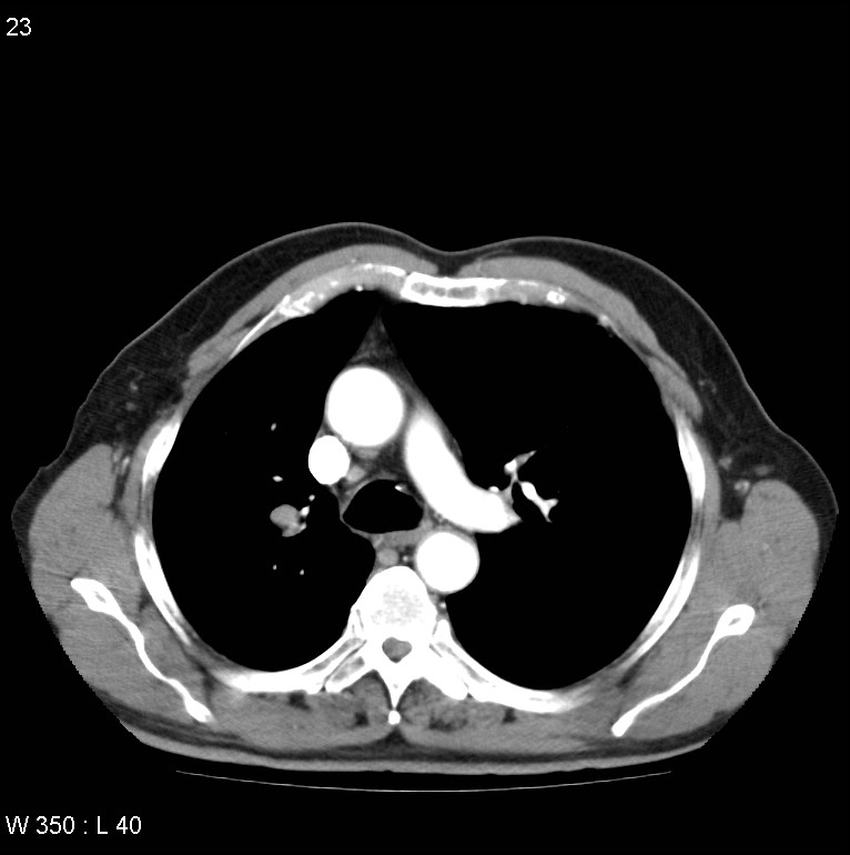Bronchial carcinoid tumor with right lower lobe collapse (Radiopaedia 29060-29422 A 22).jpg