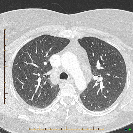 Bronchial diverticula (Radiopaedia 79512-92676 Axial lung window 60).jpg