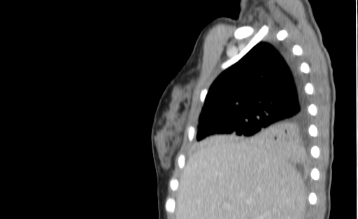 Bronchial mucoepidermoid carcinoma (Radiopaedia 57023-63895 Sagittal 32).jpg