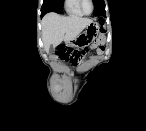 File:Bronchiectasis in Crohn disease (Radiopaedia 60311-67977 C 11).jpg