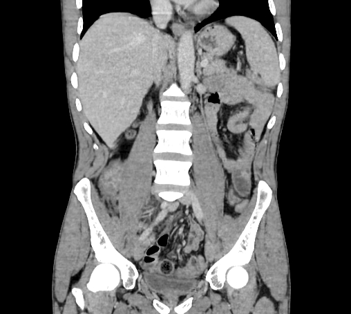 Bronchiectasis in Crohn disease (Radiopaedia 60311-67977 C 42).jpg