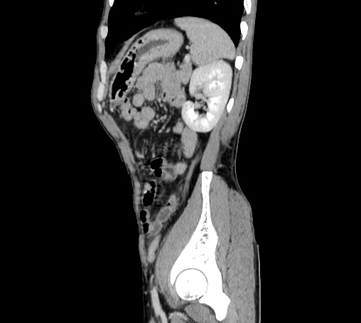 File:Bronchiectasis in Crohn disease (Radiopaedia 60311-67977 D 90).jpg