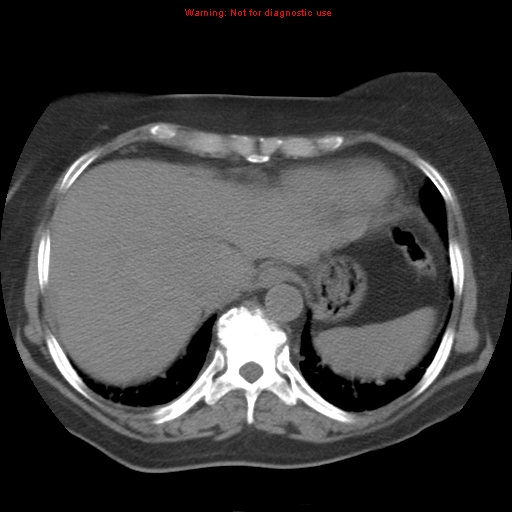 File:Bronchoalveolar carcinoma (Radiopaedia 13224-13233 Axial non-contrast 36).jpg