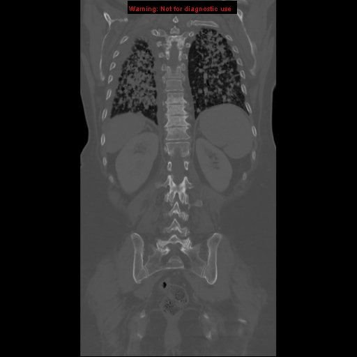 File:Bronchoalveolar carcinoma (Radiopaedia 13224-13233 Coronal non-contrast 22).jpg