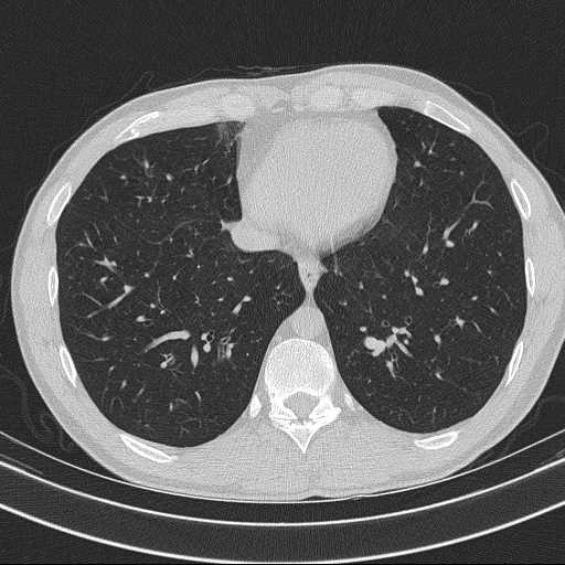 Bronchocele (Radiopaedia 60676-68429 Axial lung window 53).jpg