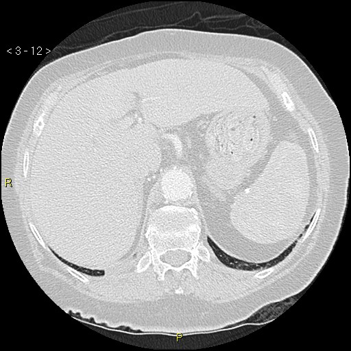 File:Bronchogenic carcinoma as an incidental finding (Radiopaedia 16453-16130 Axial lung window 12).jpg