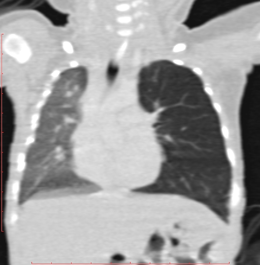 Bronchogenic cyst (Radiopaedia 78599-91409 Coronal lung window 109).jpg