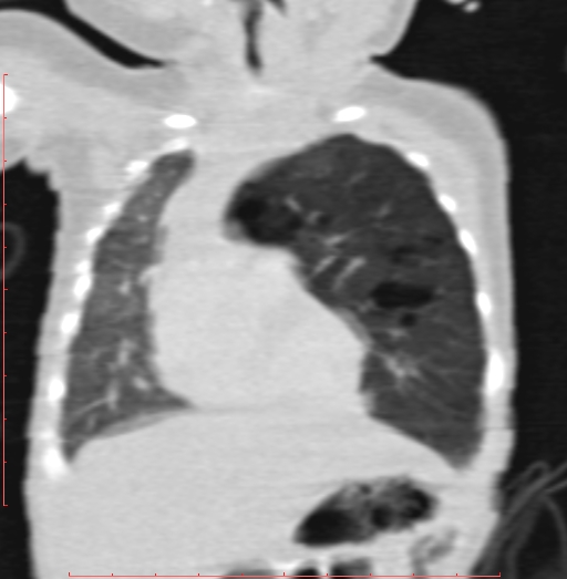 Bronchogenic cyst (Radiopaedia 78599-91409 Coronal lung window 78).jpg