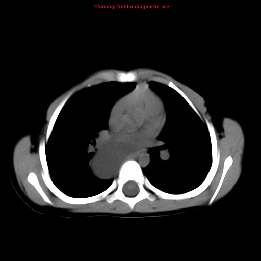 File:Bronchogenic cyst (Radiopaedia 9372-10063 Axial non-contrast 9).jpg