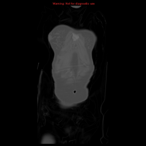 File:Brown tumor (Radiopaedia 12318-12596 D 10).jpg
