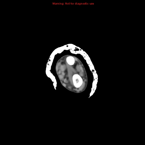 Brown tumor (Radiopaedia 12460-12694 Axial non-contrast 29).jpg