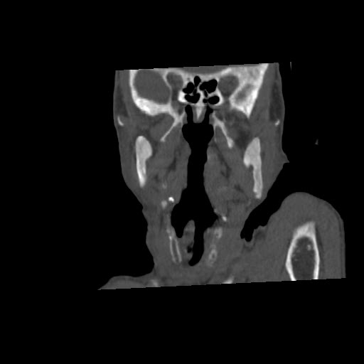 File:Brown tumor with secondary hyperparathyroidism (Radiopaedia 23591-23705 bone window 15).jpg