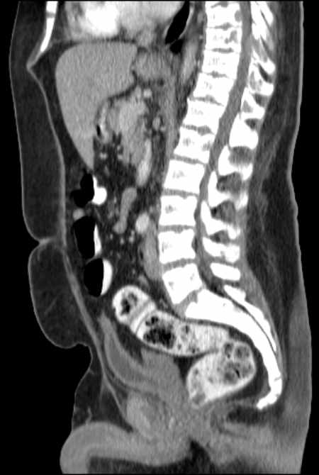 Brown tumors compressing the spinal cord (Radiopaedia 68442-77988 F 29).jpg