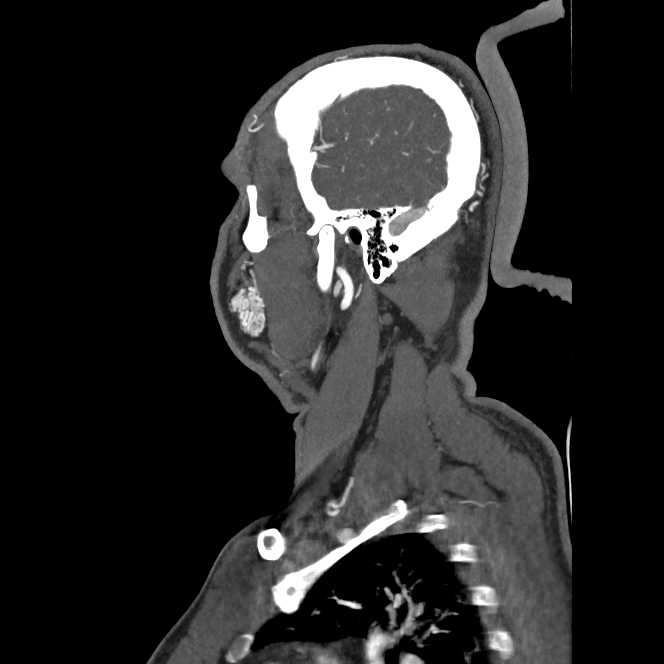 Buccal fat pad arteriovenous malformation (Radiopaedia 70936-81144 C 28).jpg