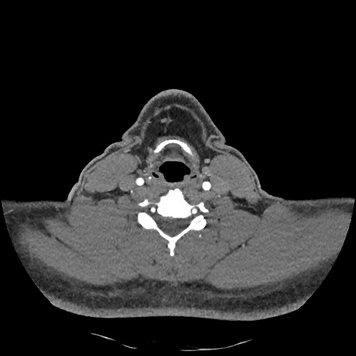 Buccal fat pad arteriovenous malformation (Radiopaedia 70936-81144 D 115).jpg