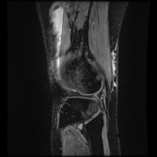 File:Bucket handle meniscus tear (Radiopaedia 56916-63751 H 10).jpg