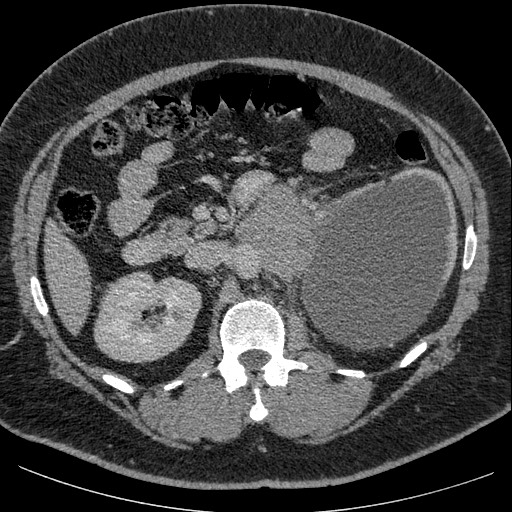 File:Burned-out testicular seminoma - retroperitoneal nodal metastases (Radiopaedia 62872-71245 A 29).jpg