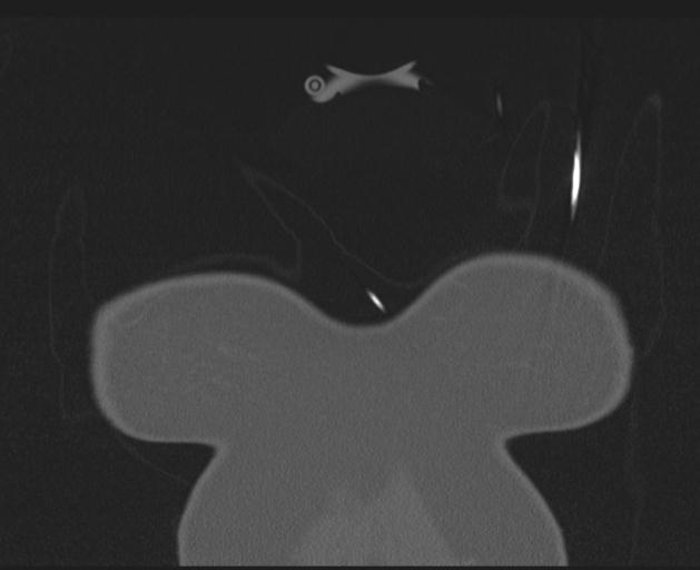 Burst fracture - thoracic spine (Radiopaedia 30238-30865 Coronal bone window 5).jpg