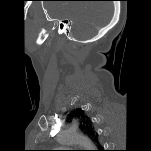File:C1 anterior arch (plough) fracture - type 1 (Radiopaedia 76181-87720 Sagittal bone window 25).jpg