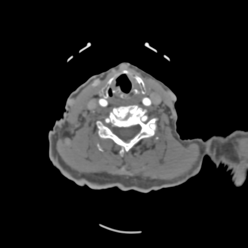 File:C2 fracture with vertebral artery dissection (Radiopaedia 37378-39200 A 110).png
