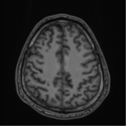 CNS vasculitis (Radiopaedia 55715-62263 Axial T1 68).png