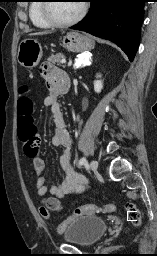 Calcified adrenal glands and Spigelian hernia (Radiopaedia 49741-54988 C 62).jpg