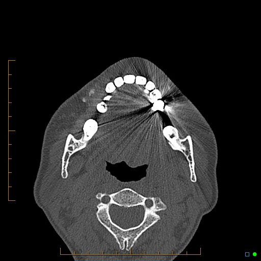 Calcified facial augmentation fillers (Radiopaedia 79514-92679 Axial bone window 109).jpg