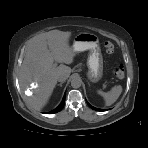 File:Calcified hepatic hydatid cyst (Radiopaedia 18907-18853 Axial non-contrast 13).jpg