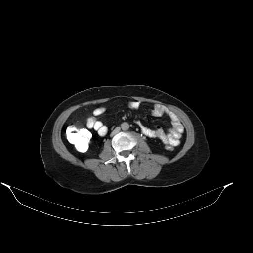 File:Calcified hydatid cyst of the liver (Radiopaedia 21212-21112 Axial C+ delayed 30).jpg