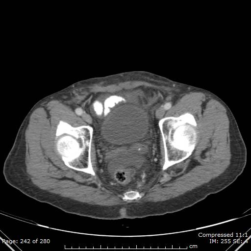 Calcified liver metastases (Radiopaedia 44699-48470 B 57).jpg