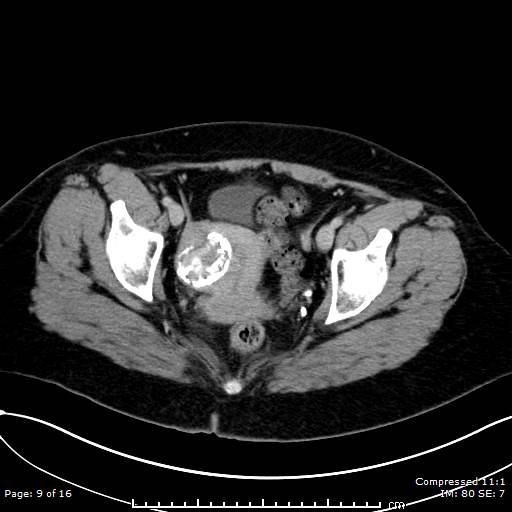 File:Calcified uterine fibroid (Radiopaedia 56077-62759 Axial C+ delayed 9).jpg