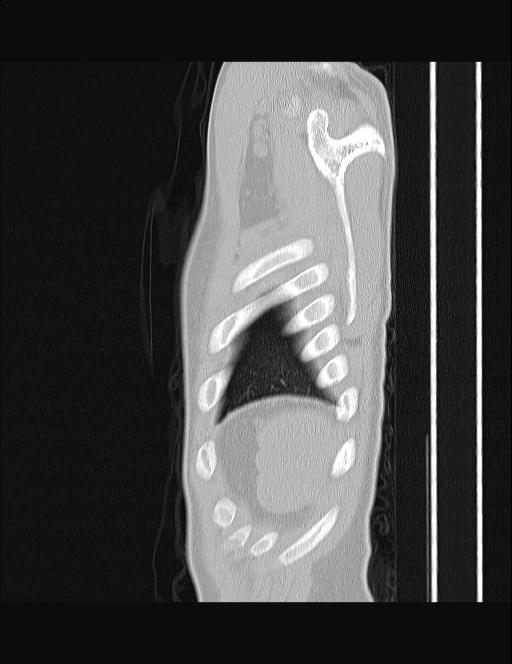 Calcifying pulmonary metastases (Radiopaedia 33359-34396 Sagittal lung window 4).jpg
