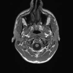Callosal dysgenesis with interhemispheric cyst (Radiopaedia 53355-59335 Axial T1 1).jpg