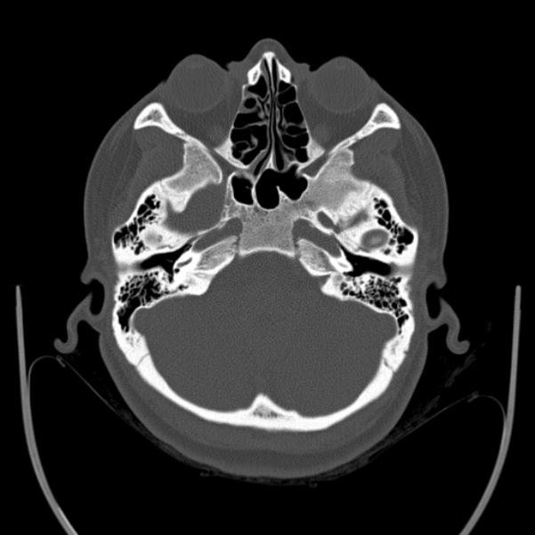 Calvarial osteoma (Radiopaedia 36520-38079 Axial bone window 24).jpg