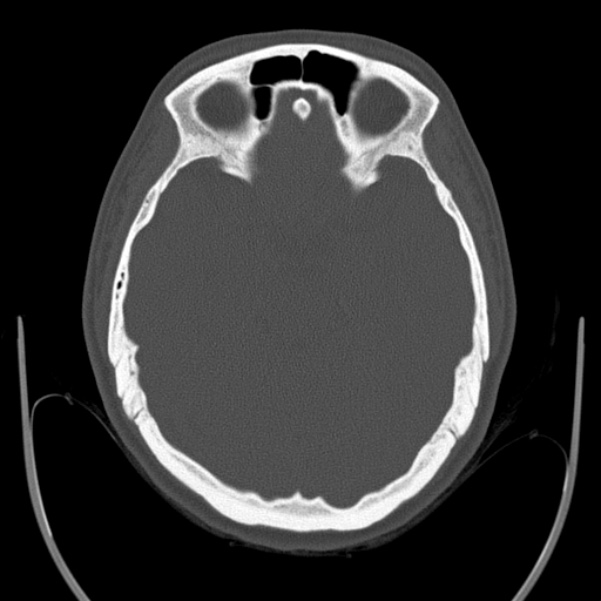 Calvarial osteoma (Radiopaedia 36520-38079 Axial bone window 39).jpg