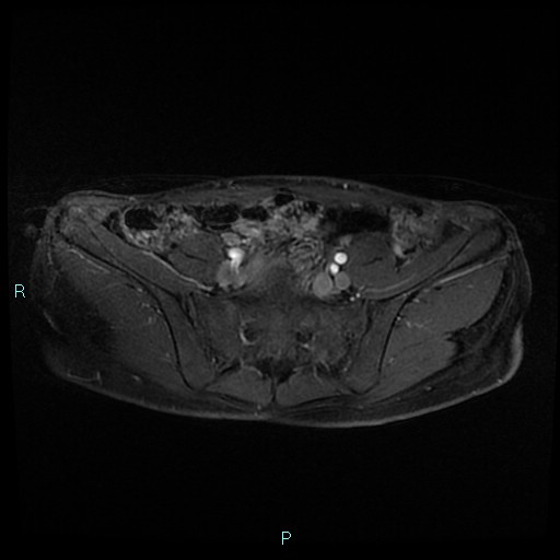 File:Canal of Nuck cyst (Radiopaedia 55074-61448 Axial T1 C+ fat sat 8).jpg