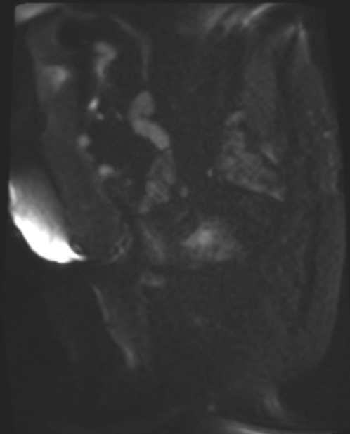 Cancer cervix - stage IIb (Radiopaedia 75411-86615 Sagittal DWI 53).jpg
