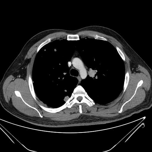 File:Cannonball pulmonary metastases (Radiopaedia 67684-77101 D 96).jpg