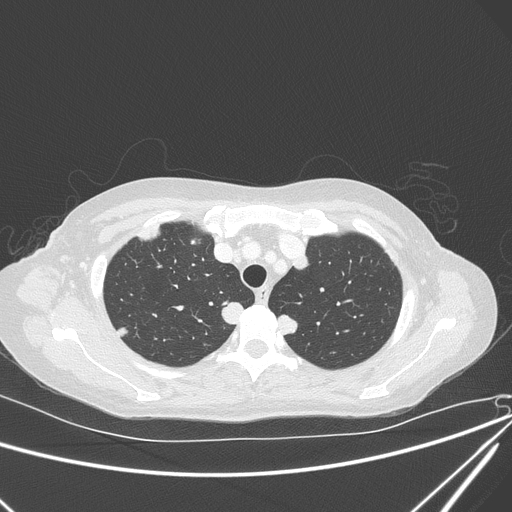 File:Canonball lung metastasis (Radiopaedia 77634-89837 Axial lung window 38).jpg