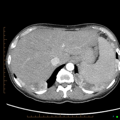 Canonball lung metastasis (Radiopaedia 77634-89837 B 93).jpg