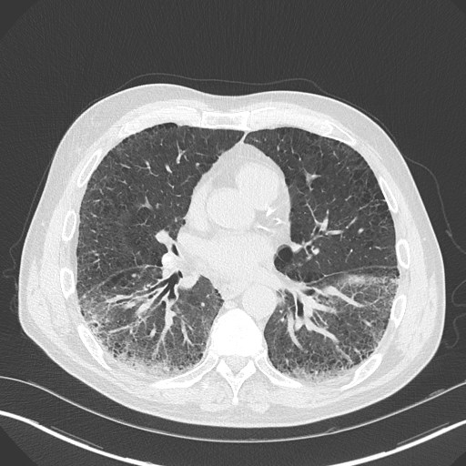 Caplan syndrome (Radiopaedia 56667-63530 Axial lung window 115).jpg