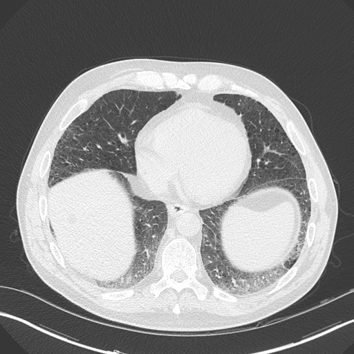 Caplan syndrome (Radiopaedia 56667-63530 Axial lung window 142).jpg
