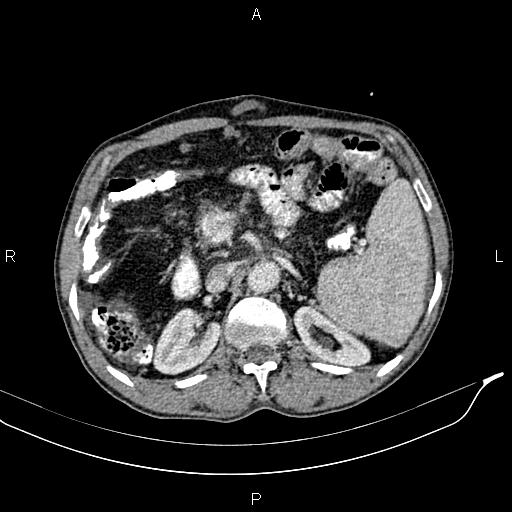 File:Caput medusae sign - portal hypertension (Radiopaedia 64007-72759 A 32).jpg