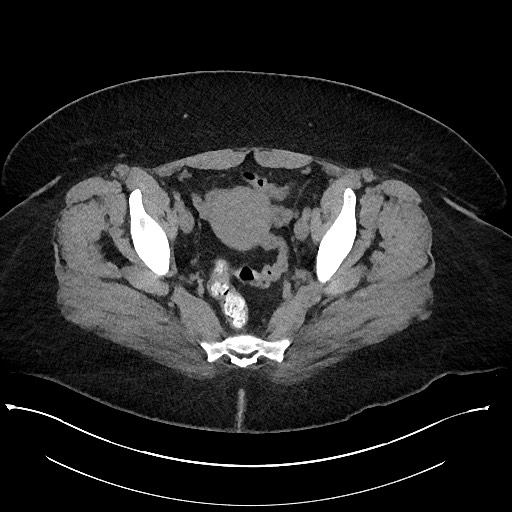 File:Carcinoid tumor - terminal ileum (Radiopaedia 60931-68740 Axial non-contrast 105).jpg