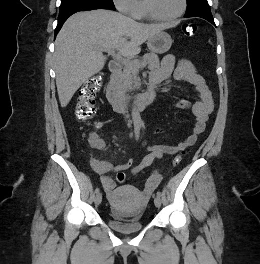 Carcinoid tumor - terminal ileum (Radiopaedia 60931-68740 Coronal non-contrast 44).jpg