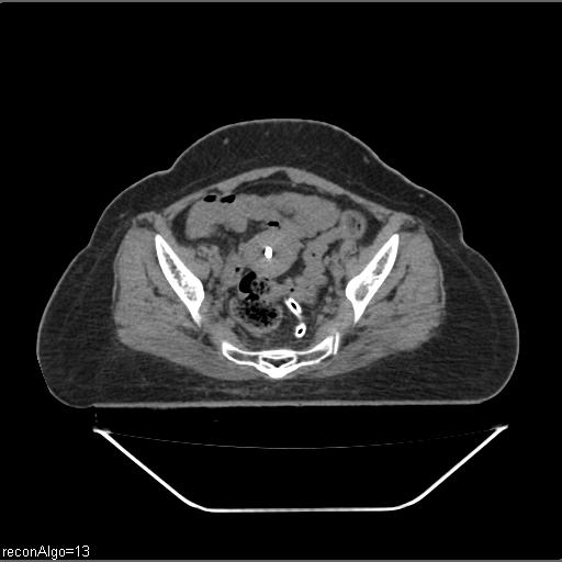 Carcinoma cervix- brachytherapy applicator (Radiopaedia 33135-34173 Axial non-contrast 20).jpg