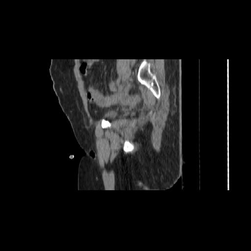 File:Carcinoma cervix- brachytherapy applicator (Radiopaedia 33135-34173 D 49).jpg