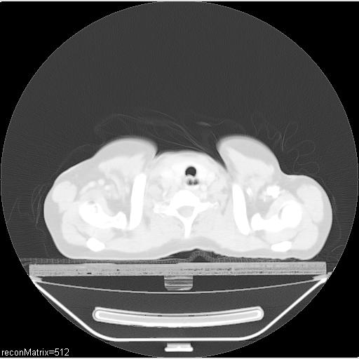 File:Carcinoma of esophagus (Radiopaedia 27356-27550 Axial lung window 32).jpg