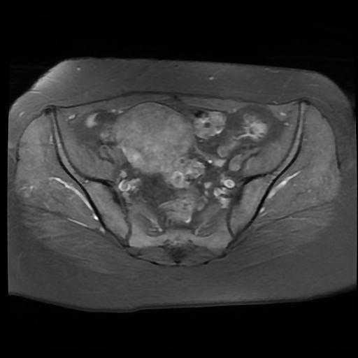 File:Carcinoma of the cervix (Radiopaedia 89018-105858 Axial T1 C+ fat sat 5).jpg